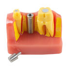 5pcs-bag 380148 5 Denshine Portable Dental Implant Analysis Crown Bridge Demonstration Teeth Tooth